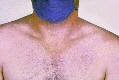 Rose spots on the chest of a patient with typhoid fever due to the bacterium Salmonella Typhi